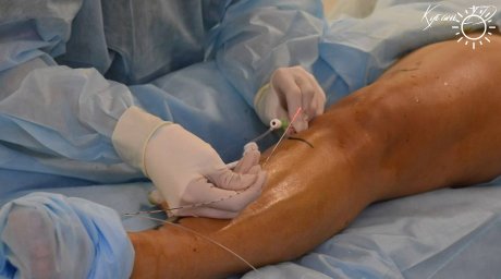 Лазерное оборудование для лечения варикозной болезни поступило в крымскую больницу