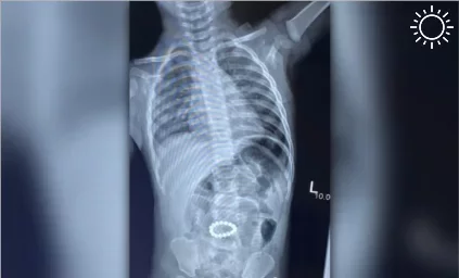Астраханские медики достали из желудка ребенка 16 магнитов