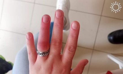 В Отрадненском районе спасатели сняли кольцо с опухшего пальца девушки
